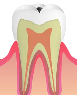 段階1（C0）