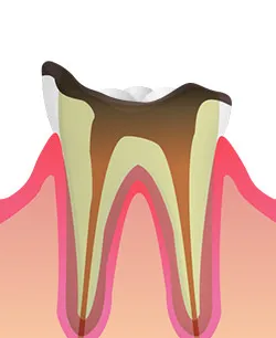 段階4（C3）